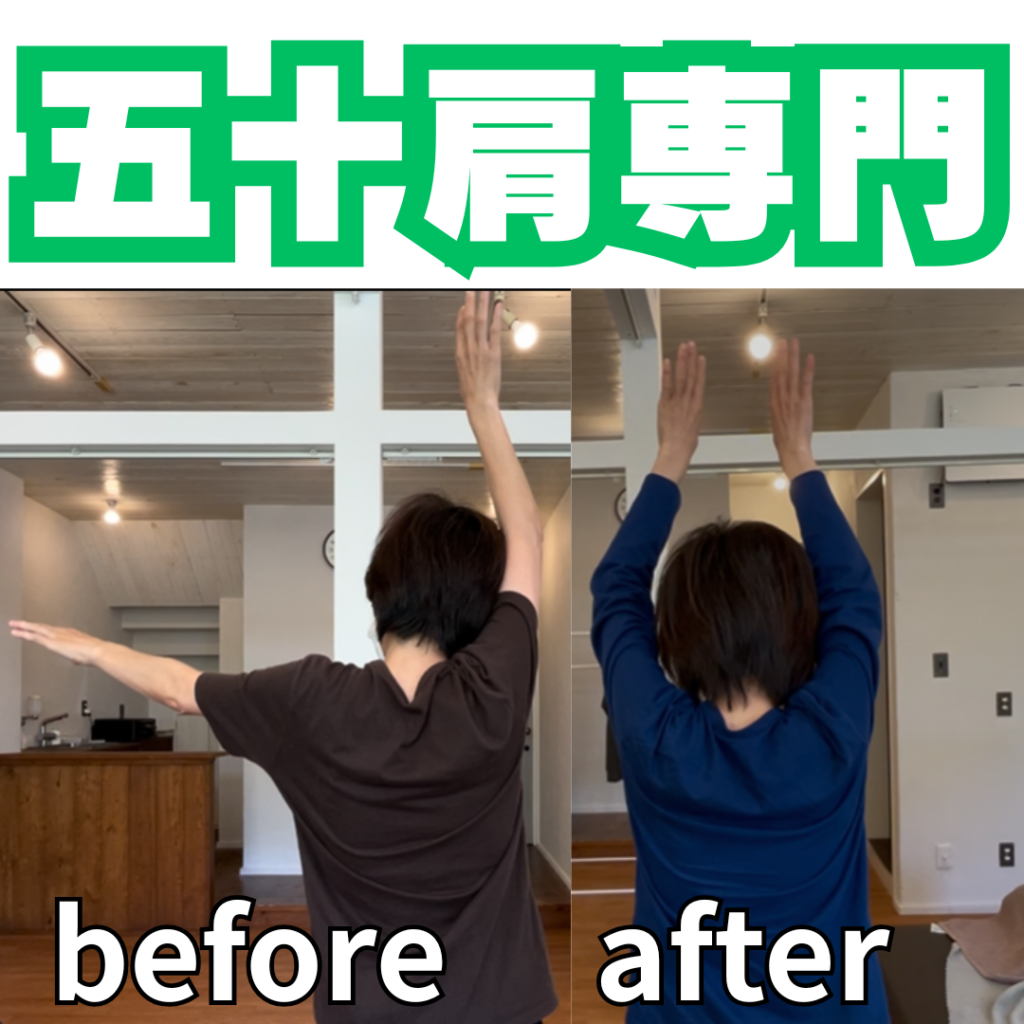 五十肩は何回で良くなる？通院回数の目安