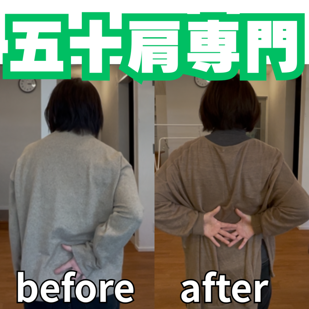 五十肩で整体に行くのは早すぎる？遅すぎる？