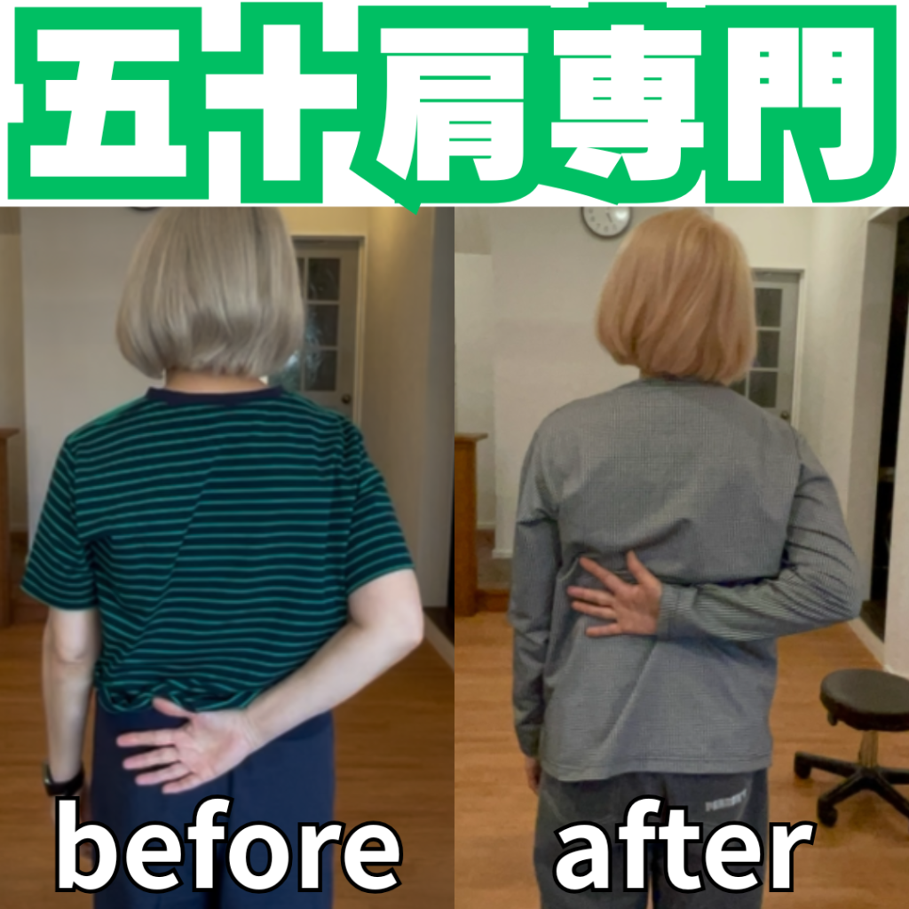 五十肩と肩こりの違いは？ポイントを専門家が解説