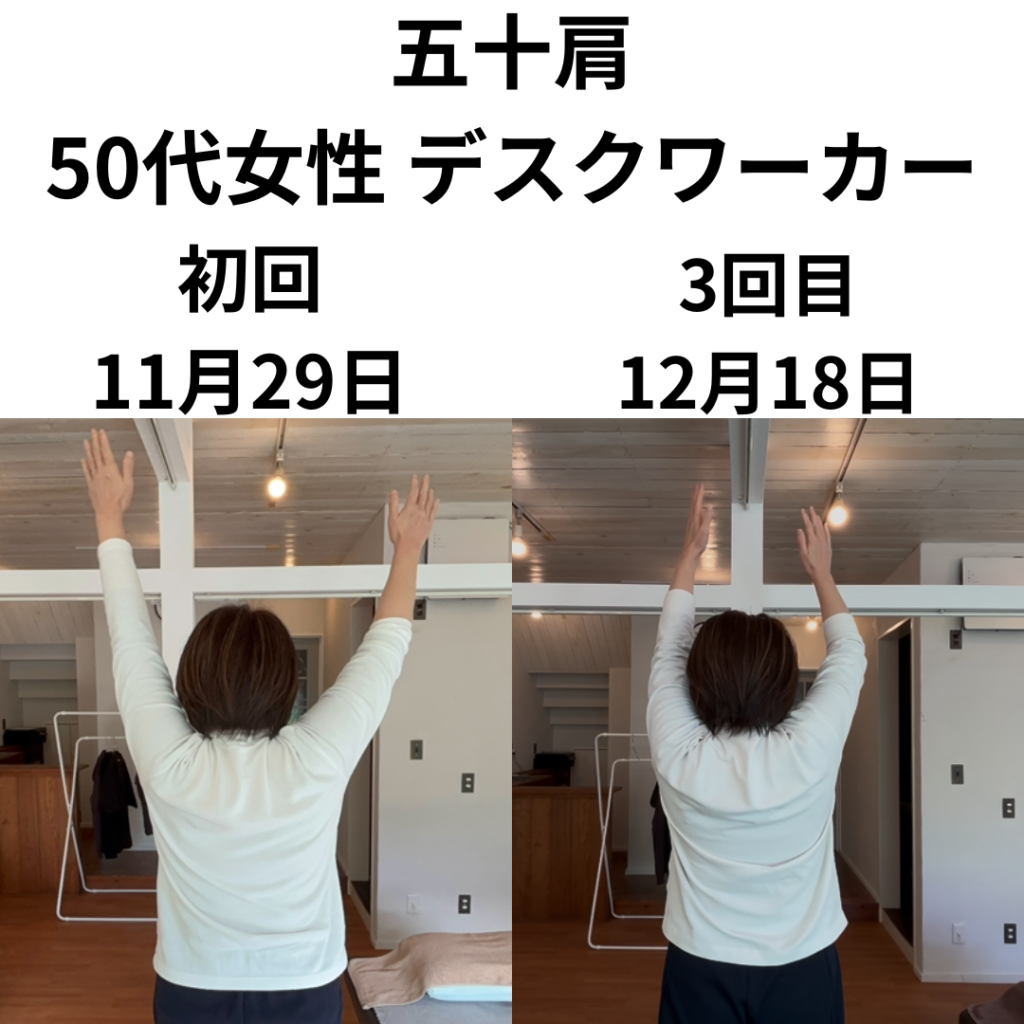 五十肩は再発する？