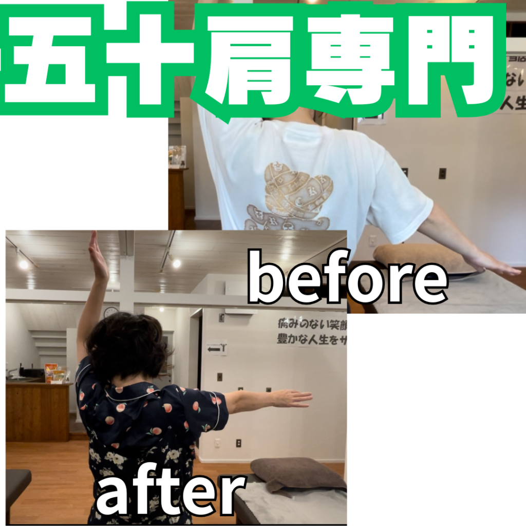 五十肩は自然に治る？